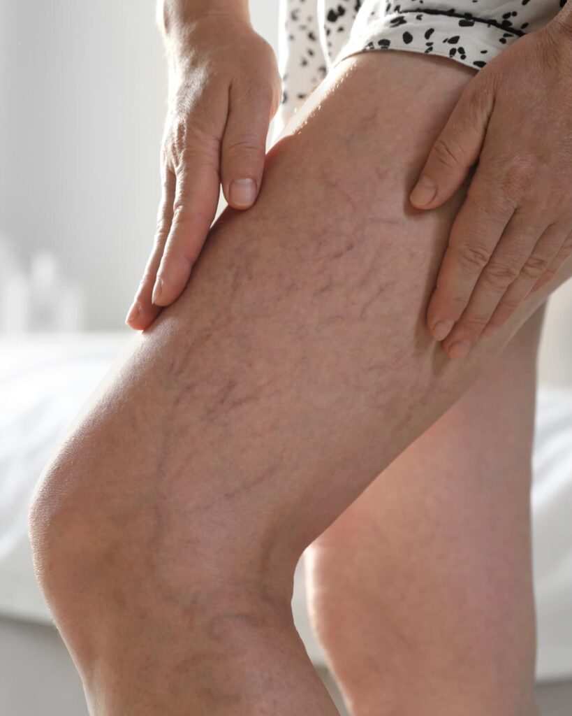 como tirar varizes recuperação da cirurgia de varizes