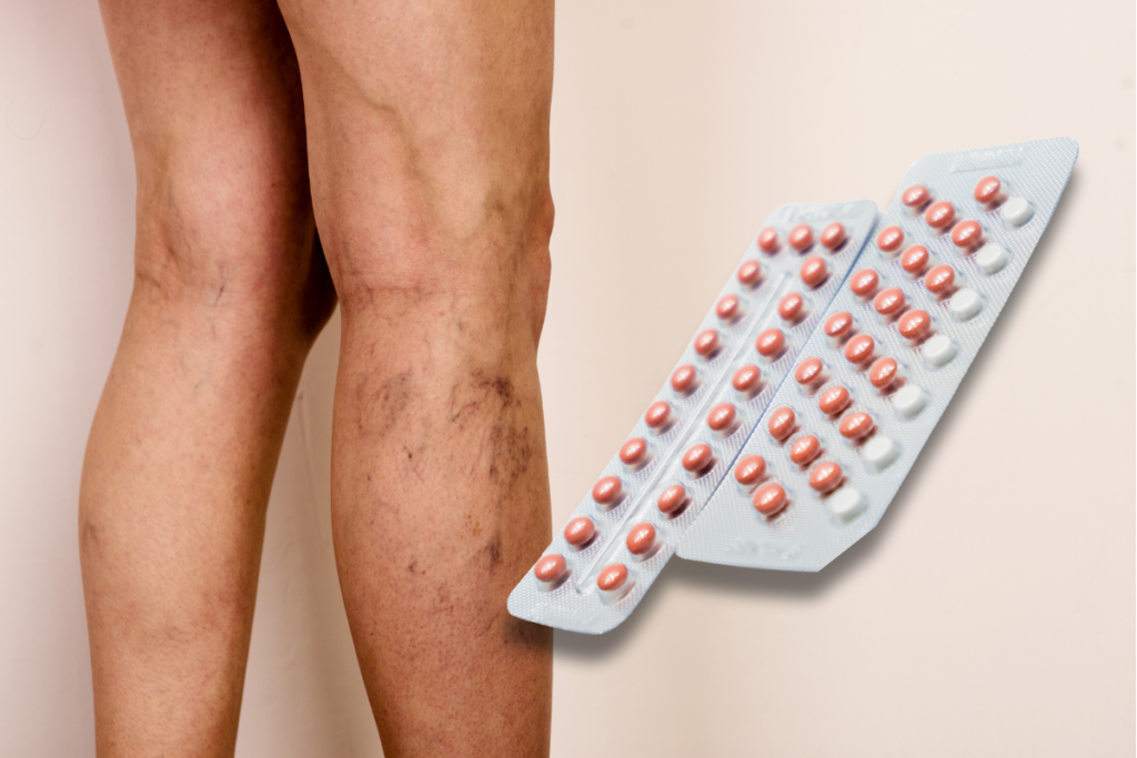 Anticoncepcional e varizes: cuidados que você precisa ter 1 anticoncepcional e varizes anticoncepcional e varizes