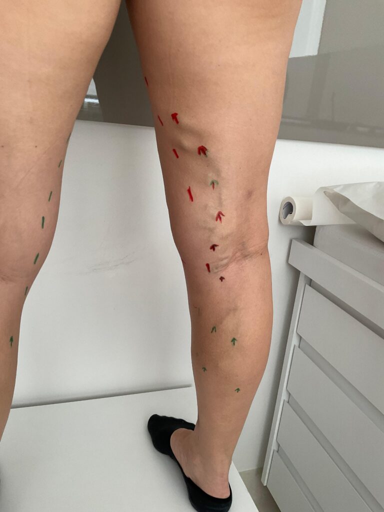 Dra Lara Rech Poltronieri 62 Endolaser - marcação antes do procedimento das veias a serem tratadas com documentação fotográfica