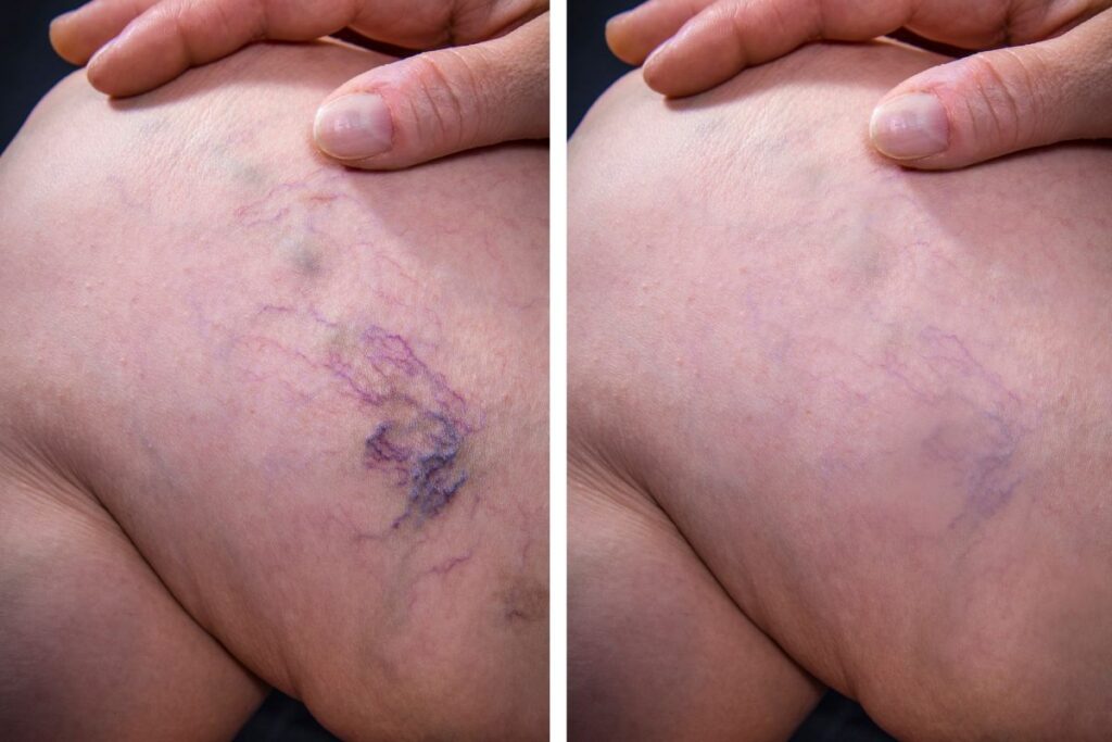 Aplicação de Varizes Antes e Depois 1 aplicação de varizes antes e depois Aplicação de Varizes Antes e Depois