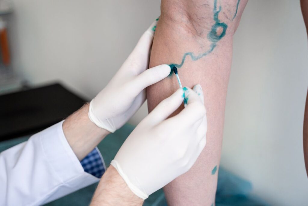 Tudo Sobre a Recuperação da Cirurgia de Varizes 2 recuperação da cirurgia de varizes Recuperação da Cirurgia de Varizes