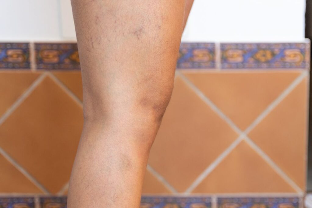 Varizes atrás do joelho: sintomas, causas e tratamentos 3 Varizes atras do joelho Como saber se estou com trombose atrás do joelho?