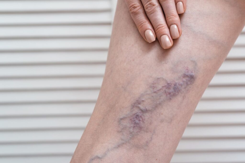 Sintomas de Varizes Inflamadas: Como Identificar e Tratar 3 Varizes atras do joelho Sintomas de Varizes inflamadas