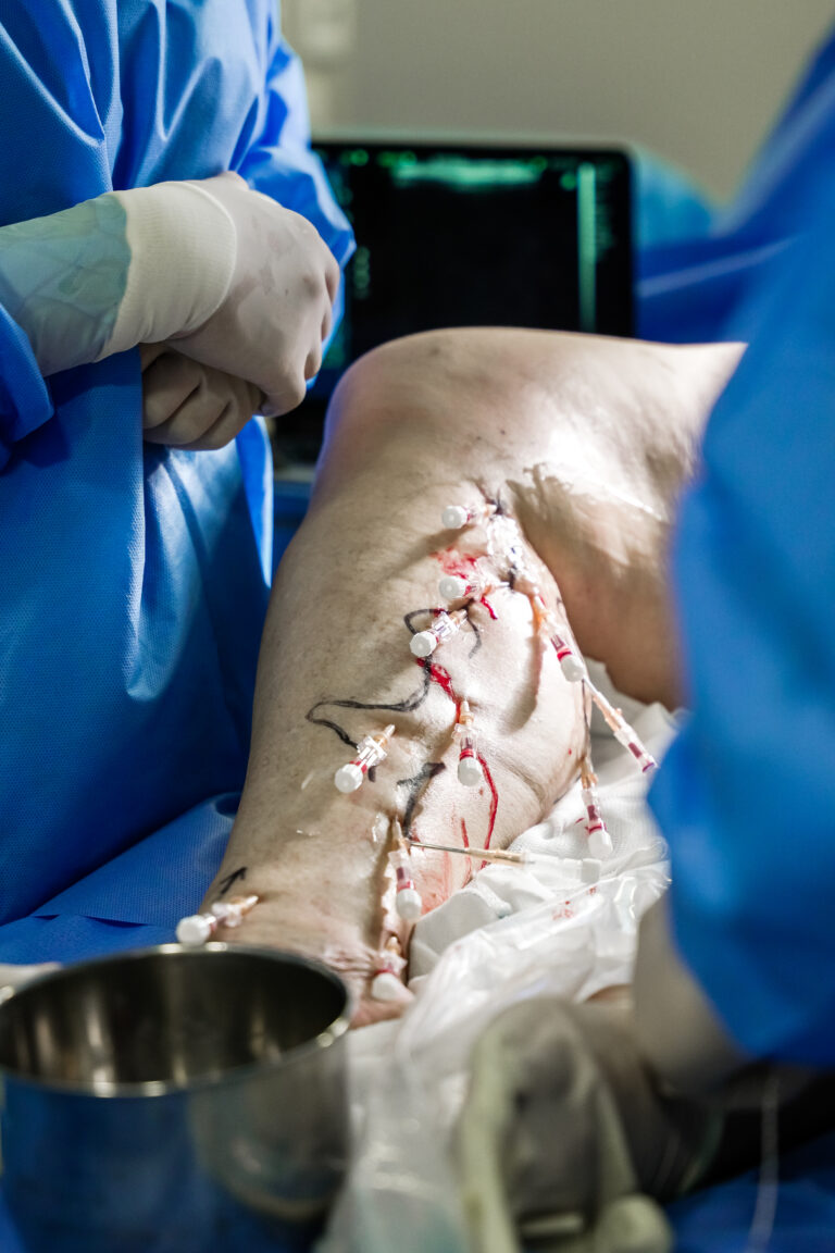 Escleroterapia com Espuma - Procedimento - Dra Lara Rech Poltronieri