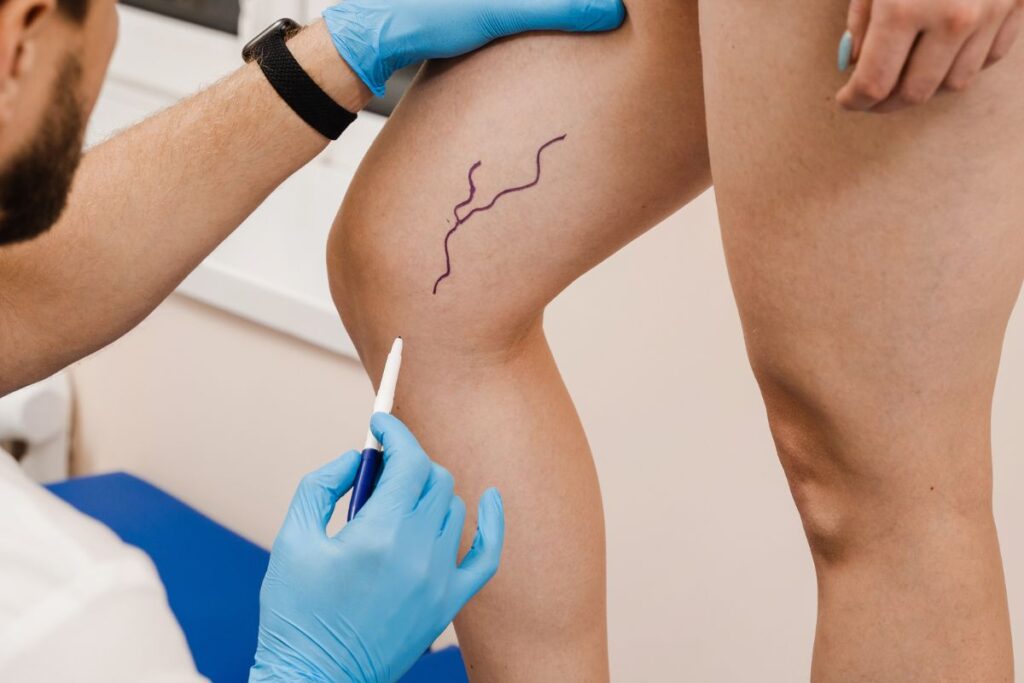 Recuperacao da Cirurgia de Varizes recuperação da cirurgia de varizes