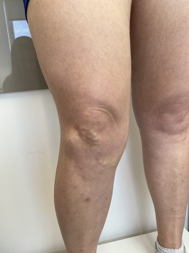 Aplicação de varizes