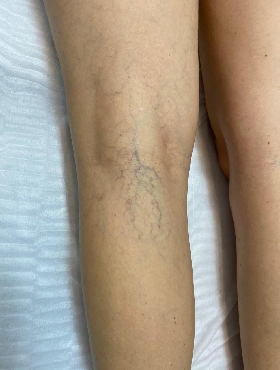 Microvarizes: o que são, causas e tratamentos modernos 1 microvarizes microvarizes 1 microvarizes