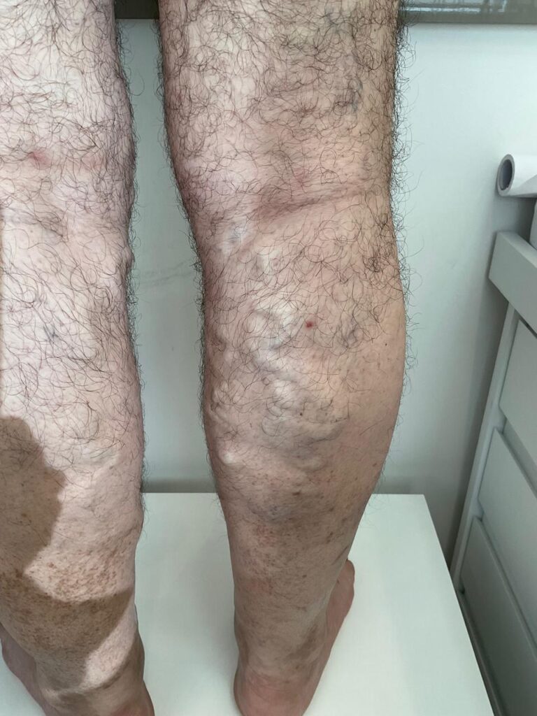 Varizes em Homem: Sintomas, Causas e Tratamentos 1 Varizes em Homem Varizes em Homem: Sintomas, Causas e Tratamentos