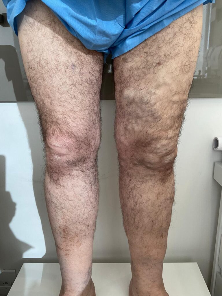 Varizes em Homem: Sintomas, Causas e Tratamentos 2 Varizes em Homem Como tratar varizes no homem