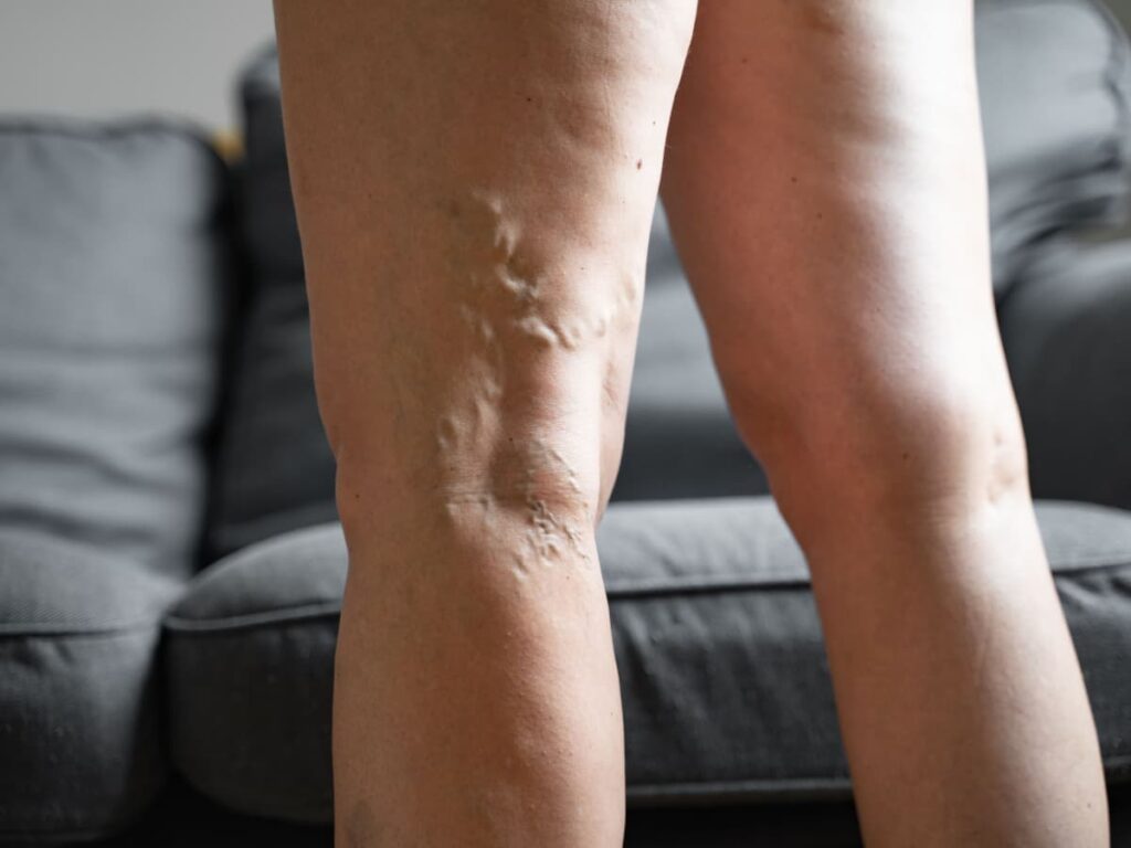 O que e bom para varizes Causas e como aliviar varizes reticulares e telangiectasias