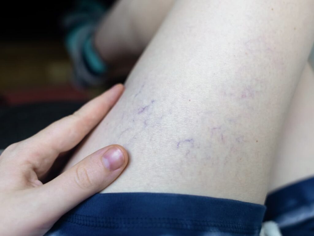 Varizes reticulares e telangiectasias varizes reticulares e telangiectasias