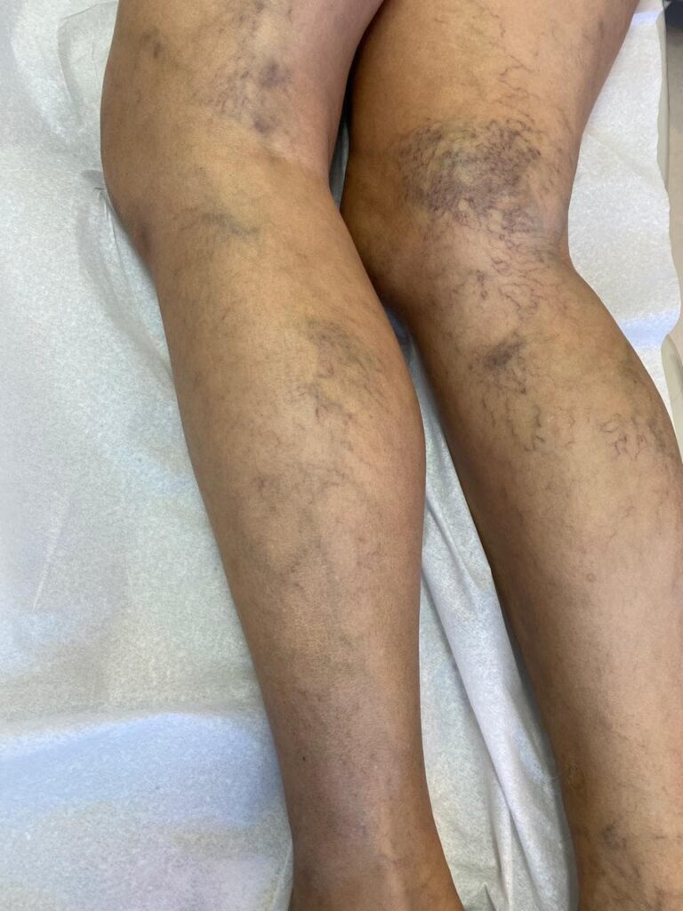 Varizes recidivadas: por que voltam e como identificar cedo 1 varizes recidivadas Varizes recidivadas: por que voltam e como identificar cedo