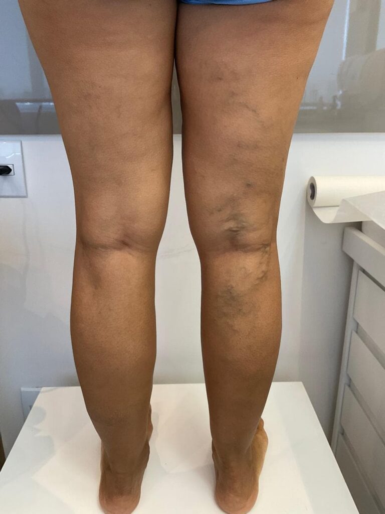 Recidiva de varizes: como evitar o retorno das veias 1 recidiva de varizes Recidiva de varizes: como evitar o retorno das veias