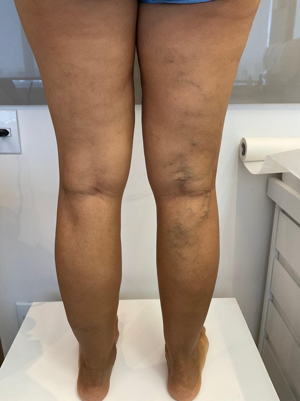 Recidiva de varizes: como evitar o retorno das veias 1 recidiva de varizes Recidiva de varizes como evitar o retorno das veias recidiva de varizes