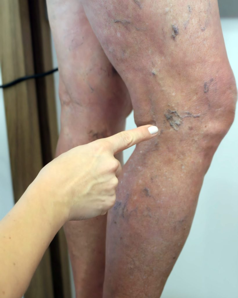 tecnica ATTA para varizes